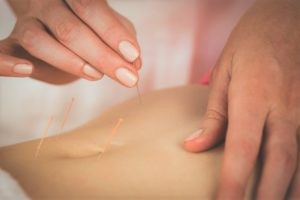 Close up of a woman's abdomen receiving an acupuncture treatment