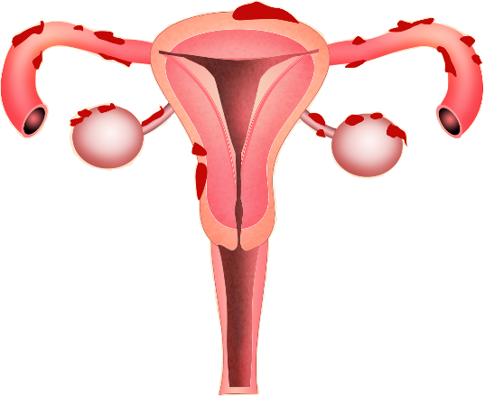 Illustration of uterus with endometrium growing on the outside 